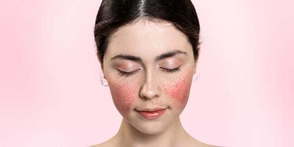 What Are The 11 Symptoms Of Lupus